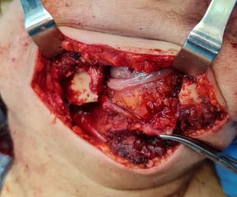 فريق طبي جراحي مُتخصص بكربلاء ينجح بإستصال ورم خبيث من فك ورقبة امرأة ثمانينية