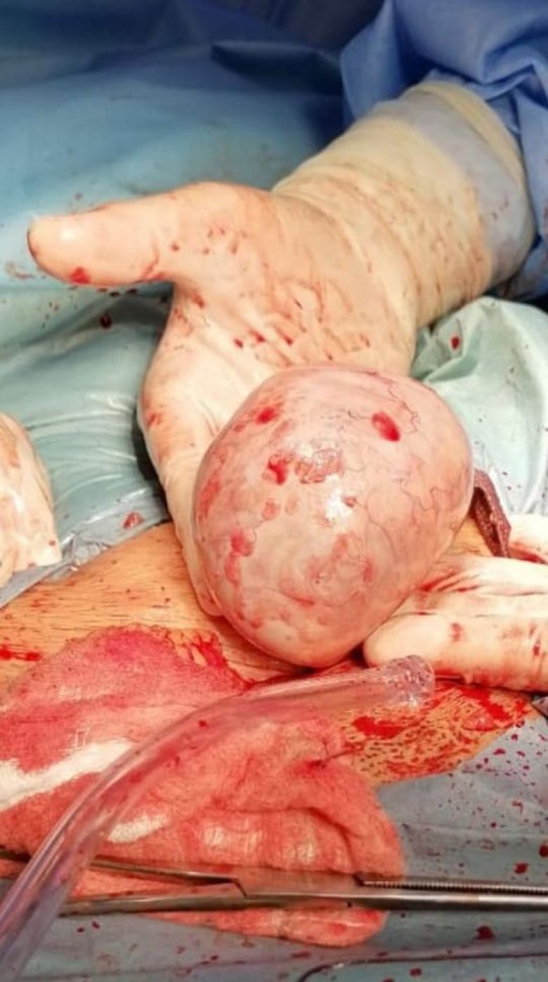نجاح عملية جراحية نوعية بكربلاء بعد استئصال كيس حمل وكتلة كبيرة داخل رحم سيدة عشرينية